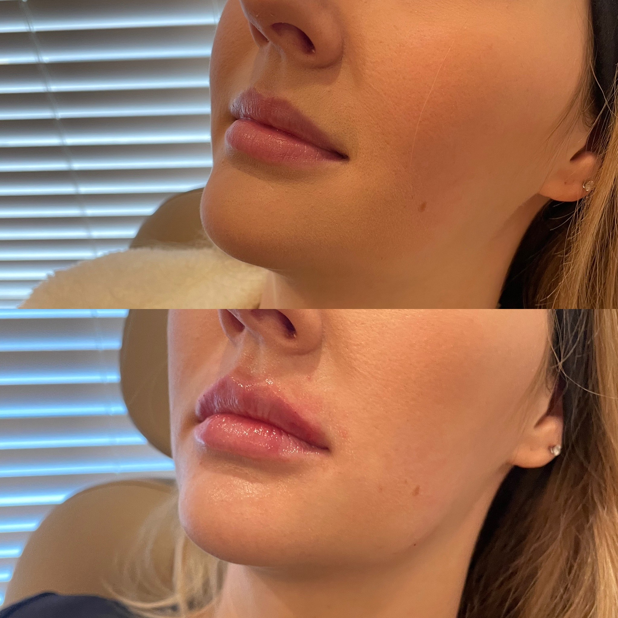 Lip Filler on patient in Bismark, ND