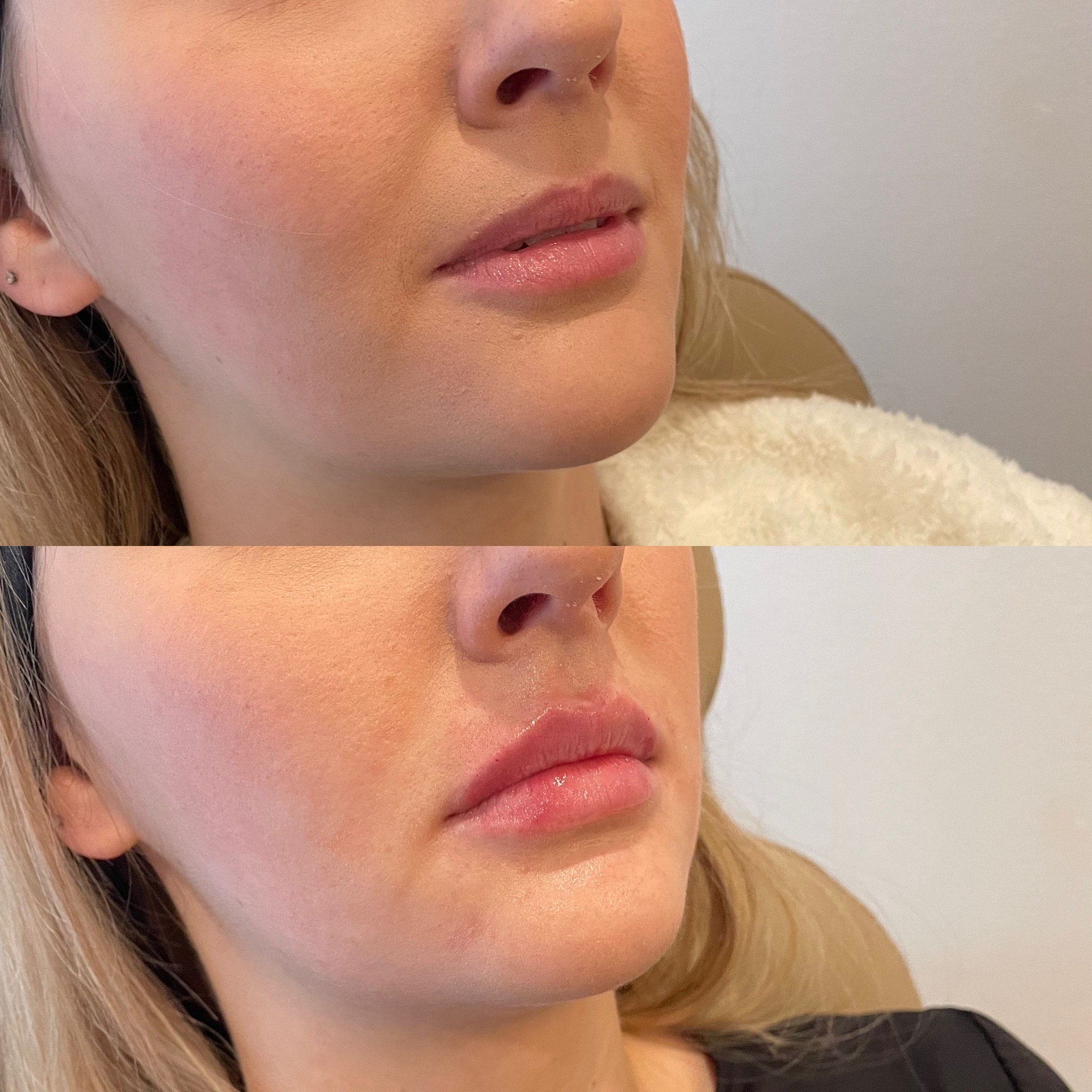 Image of a girl in Bismark ND with Lip Filler - before and after