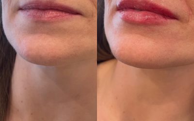 Lip Filler vs. Lip Flip in Bismarck, ND: Which is Right for You?